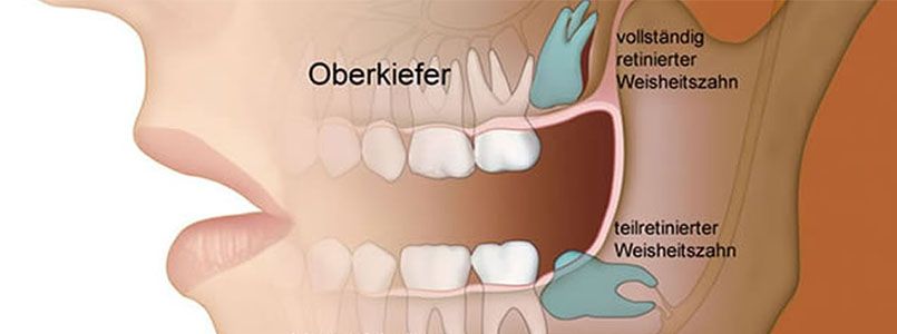 Drückt gegen zahnfleisch weisheitszahn Zahnfleischentzündung: Was