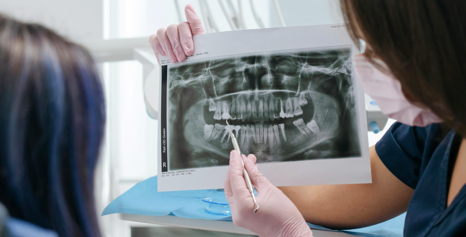 Eine zahnärztliche Röntgenaufnahme, die Karies und einen fehlenden Zahn zeigt.